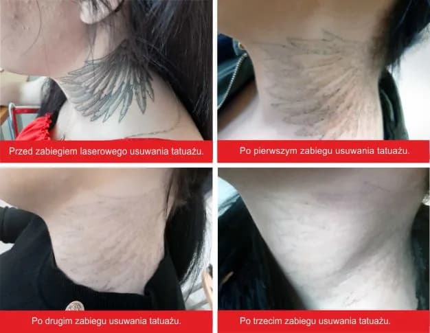Jak rozjaśnić tatuaż skutecznie i bezpiecznie – poznaj metody