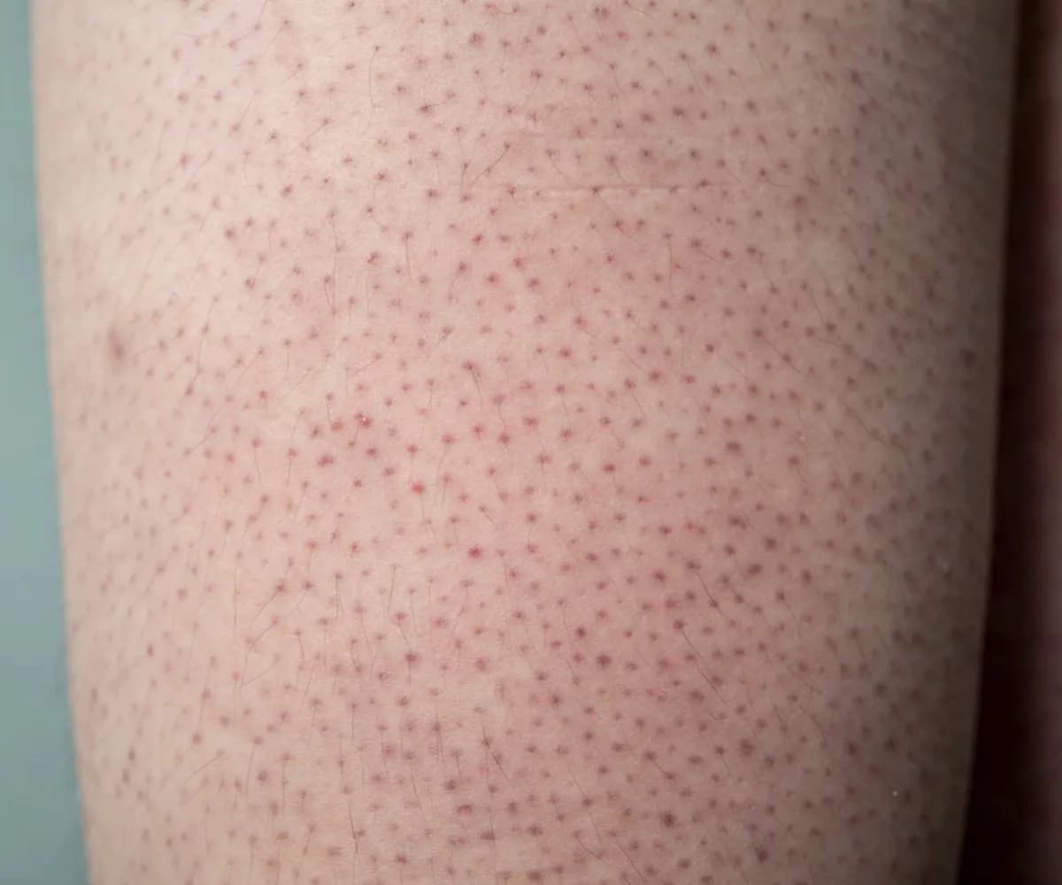 Jak pozbyć się czarnych kropek po goleniu - skuteczne metody i porady